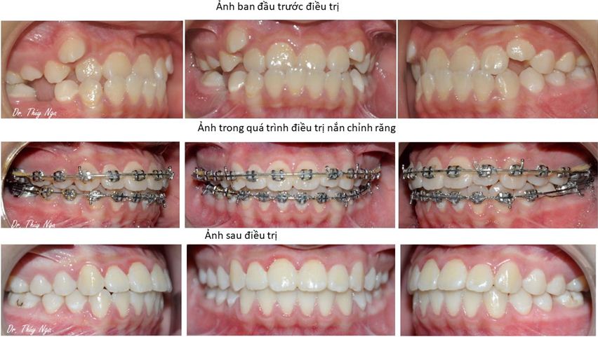 Nắn chỉnh răng với khí cụ cố định điều chỉnh móm ở hàm răng vĩnh viễn